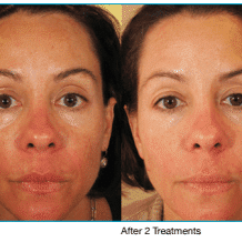Before and After Pelleve Skin Tightening Treatment Fort Worth TX